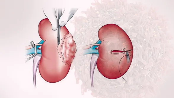 Uro Oncology